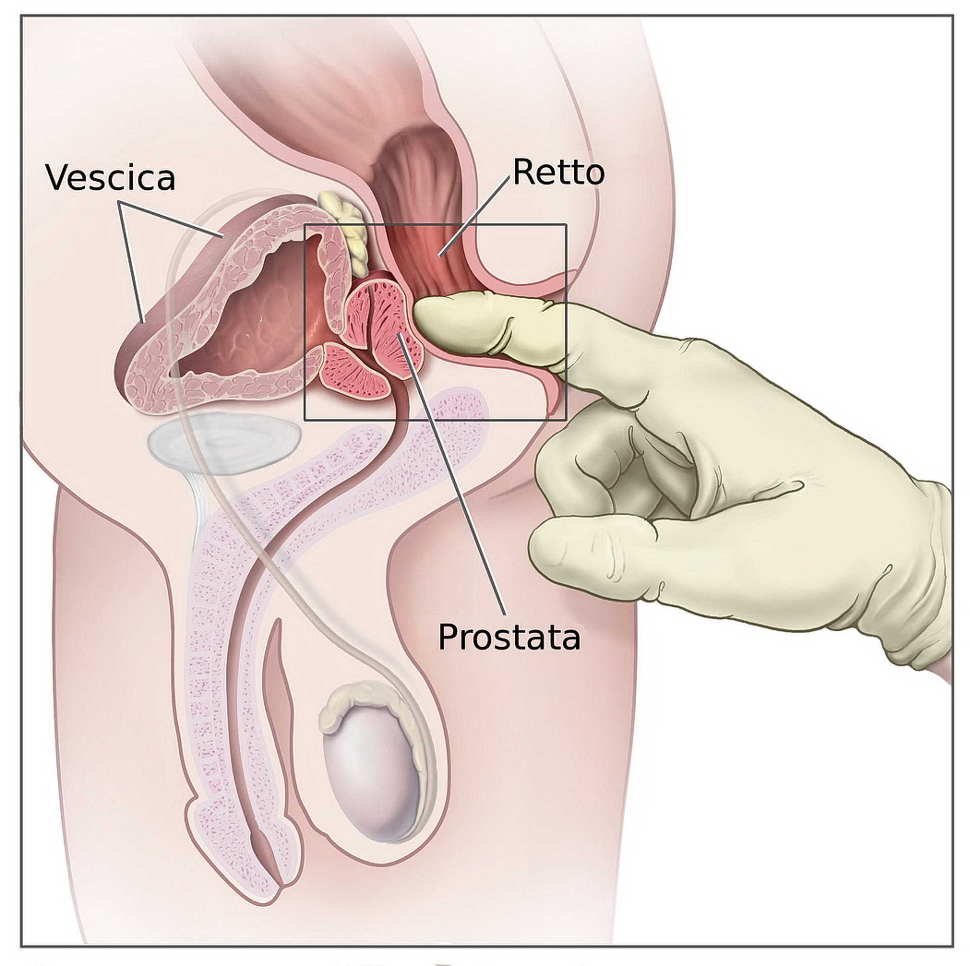 Prostatitis kezelési fájdalom az ágyékban Prosztata gyertyák OMPHYOL Ár