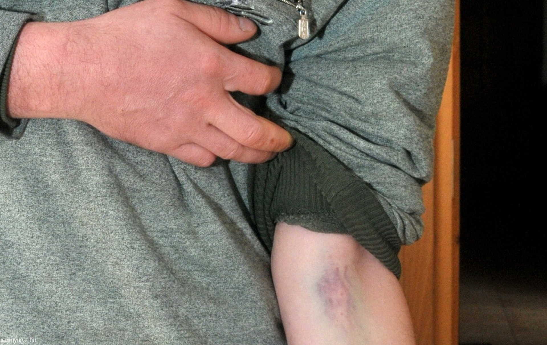 Szétbökött véna. Ötödikre, immáron bilincs nélkül sikerült vért venni
