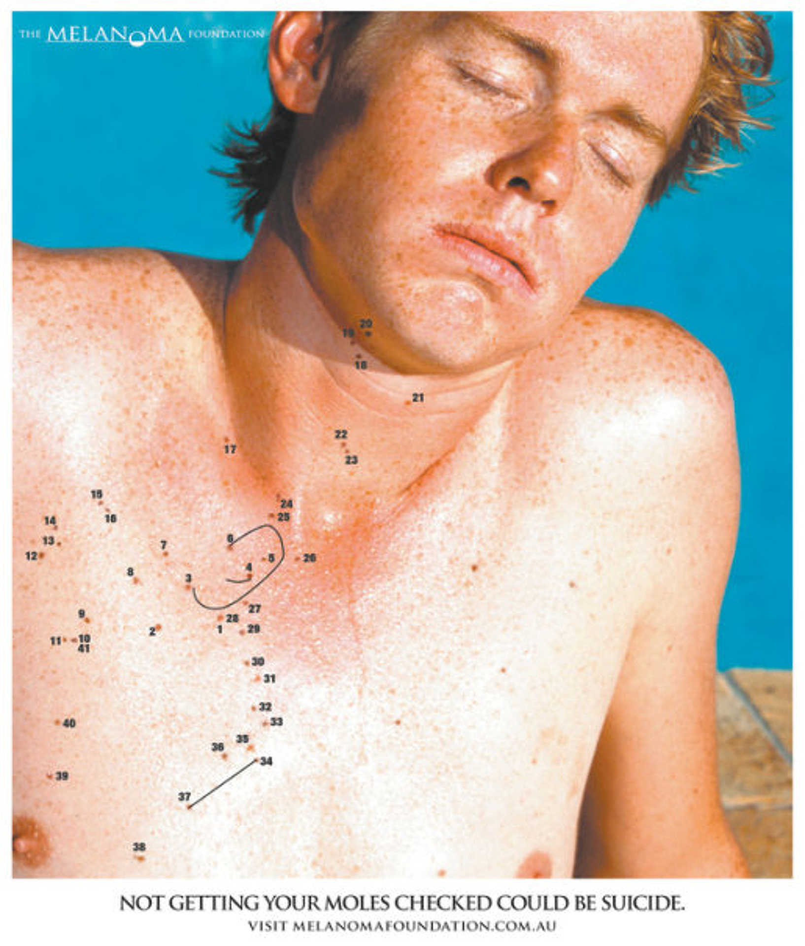 A melanoma nem játék - Ne játszunk a Nappal, mert megégethetjük magunkat!