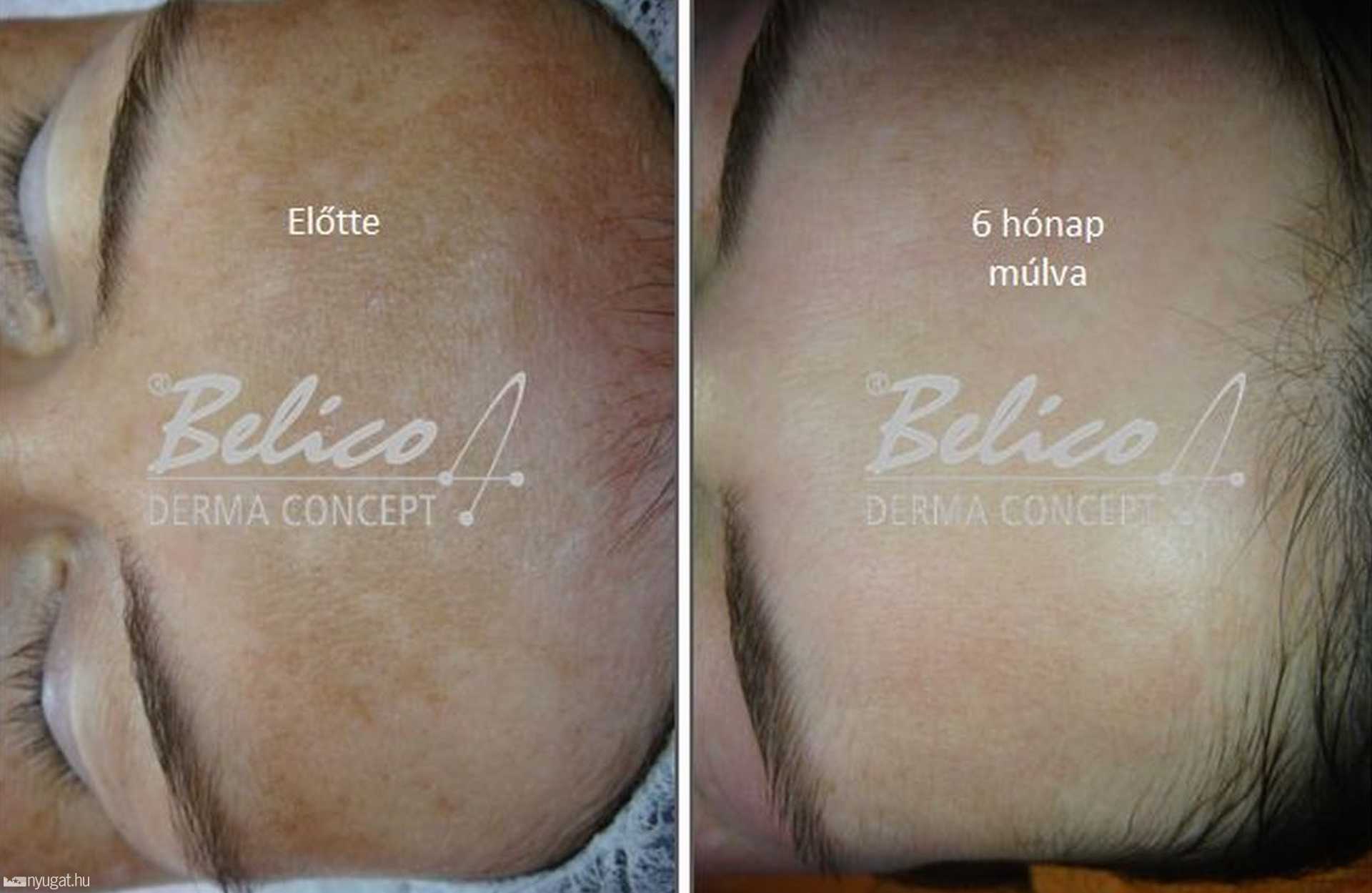 Pigmentkezelés - előtte és utána 